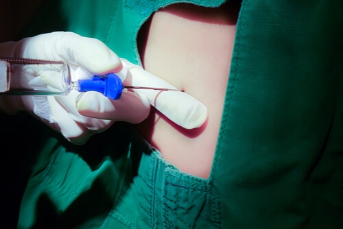 anesthesia